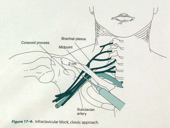 Plexus brachialis block